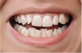 Smile before treatment, showing uneven teeth