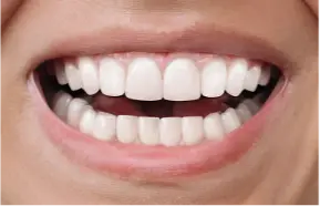 Smile after treatment, showing straight white teeth